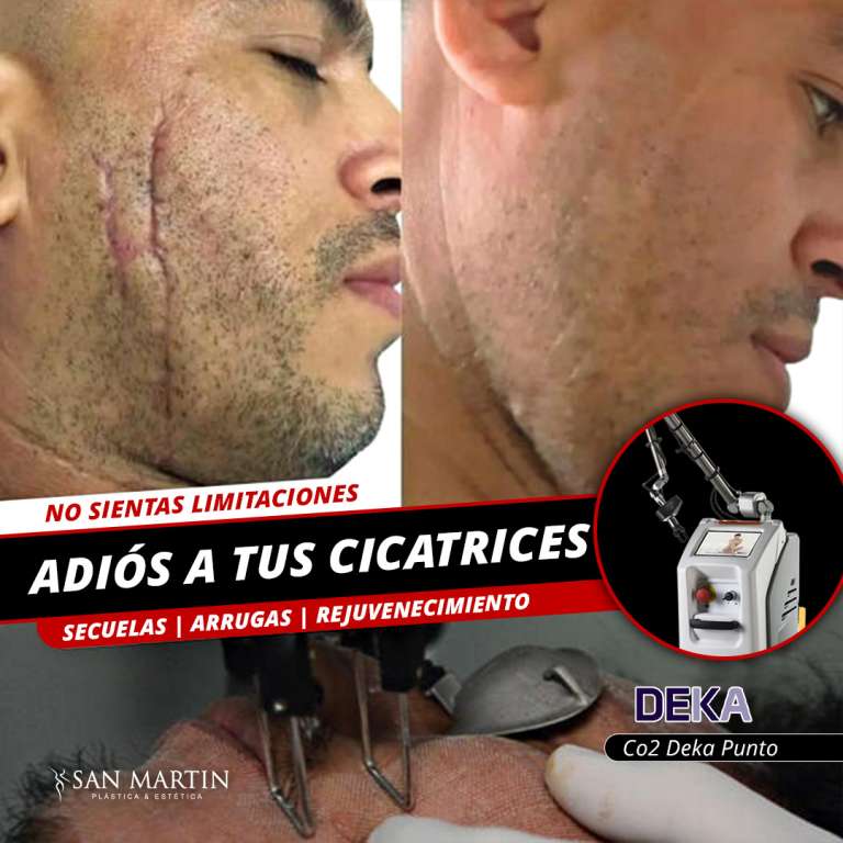 12.09.2024 - Cicatriz cachete ADS