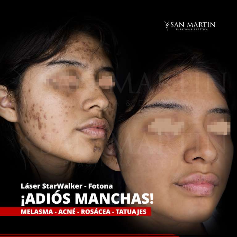 28.06.2024 - Caso 1x1 Foto completa manchas Bullying 2.1