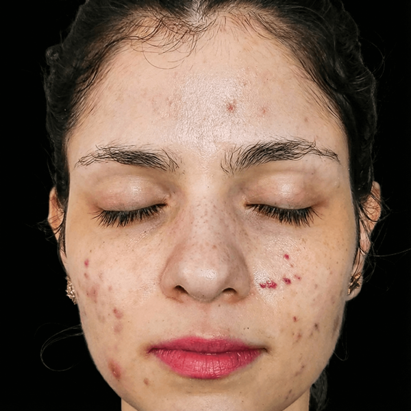 Caso Acné antes