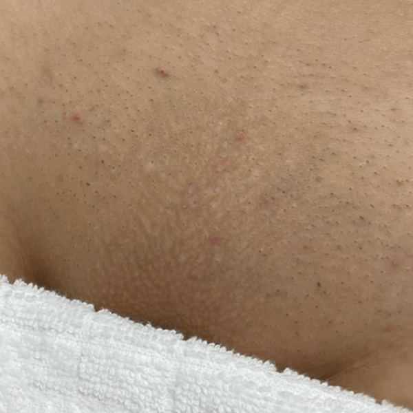 Depilación 1 Después (1)