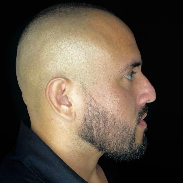 Rinomodelación antes